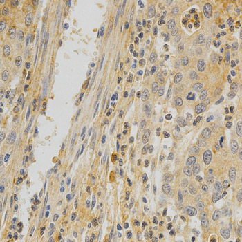 OPG / Osteoprotegerin Antibody - Immunohistochemistry of paraffin-embedded human stomach cancer tissue.
