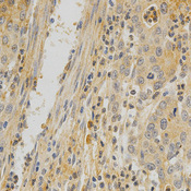 OPG / Osteoprotegerin Antibody - Immunohistochemistry of paraffin-embedded human stomach cancer tissue.