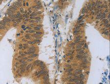 OPG / Osteoprotegerin Antibody - Immunohistochemistry of paraffin-embedded Human colon cancer using TNFRSF11B Polyclonal Antibody at dilution of 1:30.