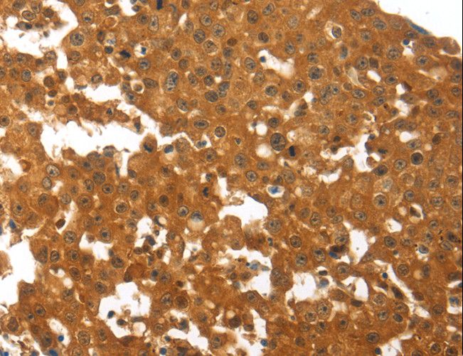 OPG / Osteoprotegerin Antibody - Immunohistochemistry of paraffin-embedded Human breast cancer using TNFRSF11B Polyclonal Antibody at dilution of 1:30.
