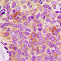OPG / Osteoprotegerin Antibody - Immunohistochemical analysis of Osteoprotegerin staining in human breast cancer formalin fixed paraffin embedded tissue section. The section was pre-treated using heat mediated antigen retrieval with sodium citrate buffer (pH 6.0). The section was then incubated with the antibody at room temperature and detected using an HRP conjugated compact polymer system. DAB was used as the chromogen. The section was then counterstained with hematoxylin and mounted with DPX.