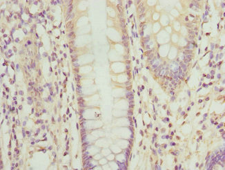 OPHN1 Antibody - Immunohistochemistry of paraffin-embedded human colon cancer at dilution 1:100