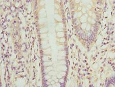 OPHN1 Antibody - Immunohistochemistry of paraffin-embedded human colon cancer at dilution 1:100