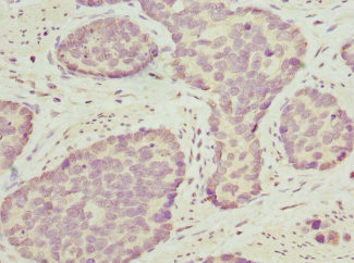 OPHN1 Antibody - Immunohistochemistry of paraffin-embedded human gastric cancer at dilution 1:100