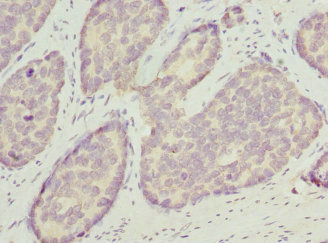 OPHN1 Antibody - Immunohistochemistry of paraffin-embedded human gastric cancer at dilution 1:100
