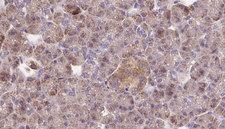 OPHN1 Antibody - 1:100 staining human pancreas carcinoma tissue by IHC-P. The sample was formaldehyde fixed and a heat mediated antigen retrieval step in citrate buffer was performed. The sample was then blocked and incubated with the antibody for 1.5 hours at 22°C. An HRP conjugated goat anti-rabbit antibody was used as the secondary.