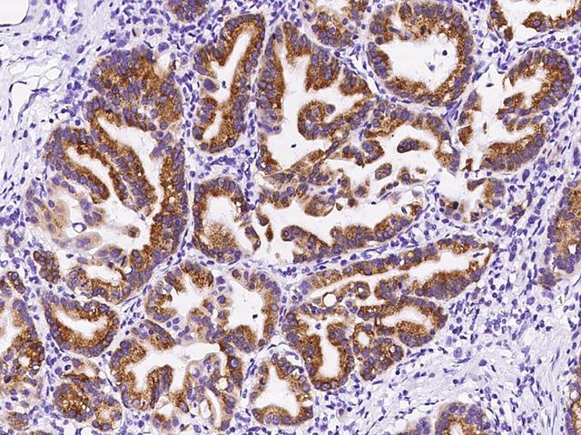 OPHN1 Antibody - Immunochemical staining of human OPHN1 in human gastric cancer with rabbit polyclonal antibody at 1:300 dilution, formalin-fixed paraffin embedded sections.