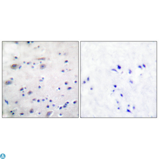 OPRM1 / Mu Opioid Receptor Antibody - Immunohistochemical analysis of paraffin-embedded Human breast cancer. Antibody was diluted at 1:100 (4°C, overnight). High-pressure and temperature Tris-EDTA, pH8.0 was used for antibody retrieval. Negative control (right) obtained from antibody was pre-absorbed by immunogen peptide.