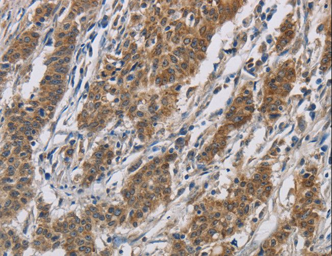 OPRS1 / SIGMAR1 Antibody - Immunohistochemistry of paraffin-embedded Human gastric cancer using SIGMAR1 Polyclonal Antibody at dilution of 1:50.