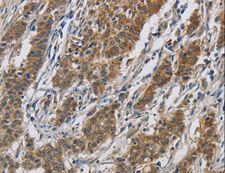 OPRS1 / SIGMAR1 Antibody - Immunohistochemistry of paraffin-embedded Human gastric cancer using SIGMAR1 Polyclonal Antibody at dilution of 1:50.