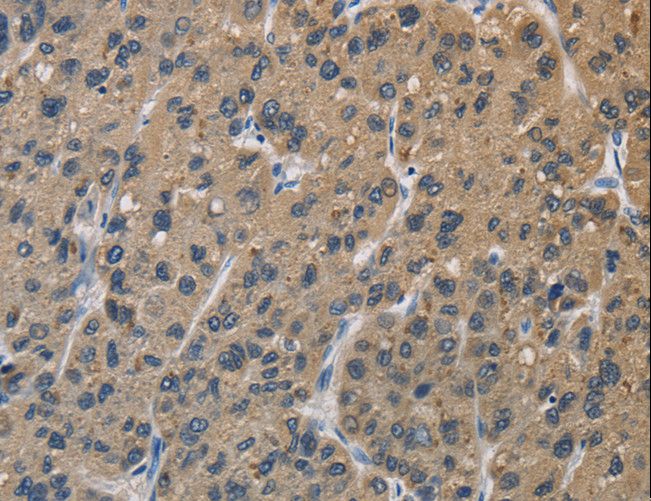 OPRS1 / SIGMAR1 Antibody - Immunohistochemistry of paraffin-embedded Human liver cancer using SIGMAR1 Polyclonal Antibody at dilution of 1:50.