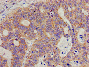 OPRS1 / SIGMAR1 Antibody - Immunohistochemistry image of paraffin-embedded human colon cancer at a dilution of 1:100