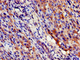 OPRS1 / SIGMAR1 Antibody - Immunohistochemistry image of paraffin-embedded human liver cancer at a dilution of 1:100