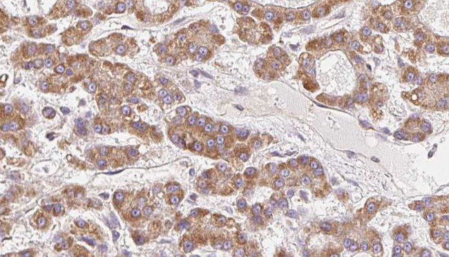 OR10H5 Antibody - 1:100 staining human liver carcinoma tissues by IHC-P. The sample was formaldehyde fixed and a heat mediated antigen retrieval step in citrate buffer was performed. The sample was then blocked and incubated with the antibody for 1.5 hours at 22°C. An HRP conjugated goat anti-rabbit antibody was used as the secondary.