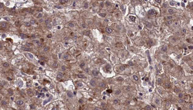 OR10Q1 Antibody - 1:100 staining human liver carcinoma tissues by IHC-P. The sample was formaldehyde fixed and a heat mediated antigen retrieval step in citrate buffer was performed. The sample was then blocked and incubated with the antibody for 1.5 hours at 22°C. An HRP conjugated goat anti-rabbit antibody was used as the secondary.