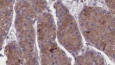 OR13C5 Antibody - 1:100 staining human liver carcinoma tissues by IHC-P. The sample was formaldehyde fixed and a heat mediated antigen retrieval step in citrate buffer was performed. The sample was then blocked and incubated with the antibody for 1.5 hours at 22°C. An HRP conjugated goat anti-rabbit antibody was used as the secondary.