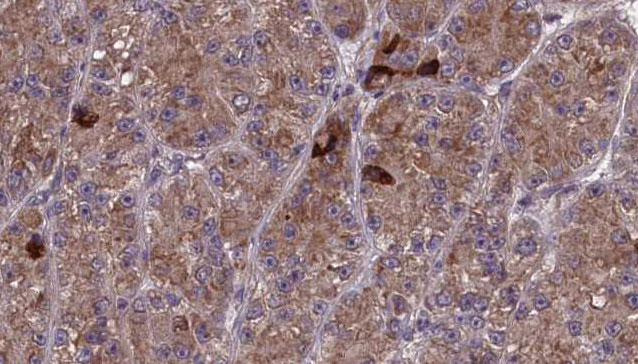 OR17-40 / OR3A1 Antibody - 1:100 staining human liver carcinoma tissues by IHC-P. The sample was formaldehyde fixed and a heat mediated antigen retrieval step in citrate buffer was performed. The sample was then blocked and incubated with the antibody for 1.5 hours at 22°C. An HRP conjugated goat anti-rabbit antibody was used as the secondary.