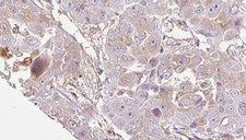 OR1E1 Antibody - 1:100 staining human liver carcinoma tissues by IHC-P. The sample was formaldehyde fixed and a heat mediated antigen retrieval step in citrate buffer was performed. The sample was then blocked and incubated with the antibody for 1.5 hours at 22°C. An HRP conjugated goat anti-rabbit antibody was used as the secondary.