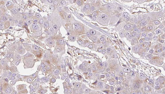 OR1E2 Antibody - 1:100 staining human liver carcinoma tissues by IHC-P. The sample was formaldehyde fixed and a heat mediated antigen retrieval step in citrate buffer was performed. The sample was then blocked and incubated with the antibody for 1.5 hours at 22°C. An HRP conjugated goat anti-rabbit antibody was used as the secondary.