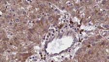 OR1F1 Antibody - 1:100 staining human liver carcinoma tissues by IHC-P. The sample was formaldehyde fixed and a heat mediated antigen retrieval step in citrate buffer was performed. The sample was then blocked and incubated with the antibody for 1.5 hours at 22°C. An HRP conjugated goat anti-rabbit antibody was used as the secondary.