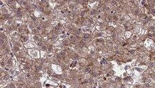 OR1G1 Antibody - 1:100 staining human liver carcinoma tissues by IHC-P. The sample was formaldehyde fixed and a heat mediated antigen retrieval step in citrate buffer was performed. The sample was then blocked and incubated with the antibody for 1.5 hours at 22°C. An HRP conjugated goat anti-rabbit antibody was used as the secondary.