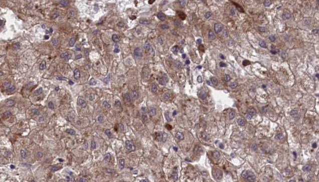 OR1I1 Antibody - 1:100 staining human liver carcinoma tissues by IHC-P. The sample was formaldehyde fixed and a heat mediated antigen retrieval step in citrate buffer was performed. The sample was then blocked and incubated with the antibody for 1.5 hours at 22°C. An HRP conjugated goat anti-rabbit antibody was used as the secondary.