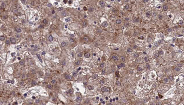 OR1J1 Antibody - 1:100 staining human liver carcinoma tissues by IHC-P. The sample was formaldehyde fixed and a heat mediated antigen retrieval step in citrate buffer was performed. The sample was then blocked and incubated with the antibody for 1.5 hours at 22°C. An HRP conjugated goat anti-rabbit antibody was used as the secondary.