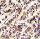 OR1J4 Antibody - OR1J4 antibody immunohistochemistry of formalin-fixed and paraffin-embedded human testis carcinoma followed by peroxidase-conjugated secondary antibody and DAB staining.