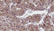 OR1J4 Antibody - 1:100 staining human liver carcinoma tissues by IHC-P. The sample was formaldehyde fixed and a heat mediated antigen retrieval step in citrate buffer was performed. The sample was then blocked and incubated with the antibody for 1.5 hours at 22°C. An HRP conjugated goat anti-rabbit antibody was used as the secondary.