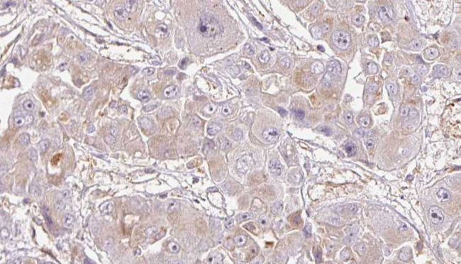 OR1K1 Antibody - 1:100 staining human liver carcinoma tissues by IHC-P. The sample was formaldehyde fixed and a heat mediated antigen retrieval step in citrate buffer was performed. The sample was then blocked and incubated with the antibody for 1.5 hours at 22°C. An HRP conjugated goat anti-rabbit antibody was used as the secondary.