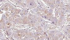 OR1K1 Antibody - 1:100 staining human liver carcinoma tissues by IHC-P. The sample was formaldehyde fixed and a heat mediated antigen retrieval step in citrate buffer was performed. The sample was then blocked and incubated with the antibody for 1.5 hours at 22°C. An HRP conjugated goat anti-rabbit antibody was used as the secondary.