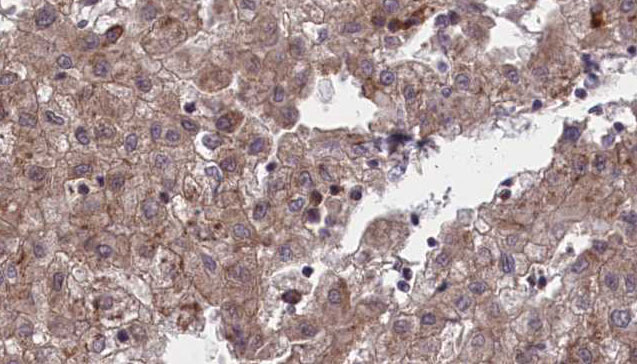 OR1L1 Antibody - 1:100 staining human liver carcinoma tissues by IHC-P. The sample was formaldehyde fixed and a heat mediated antigen retrieval step in citrate buffer was performed. The sample was then blocked and incubated with the antibody for 1.5 hours at 22°C. An HRP conjugated goat anti-rabbit antibody was used as the secondary.