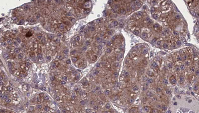 OR1L3 Antibody - 1:100 staining human liver carcinoma tissues by IHC-P. The sample was formaldehyde fixed and a heat mediated antigen retrieval step in citrate buffer was performed. The sample was then blocked and incubated with the antibody for 1.5 hours at 22°C. An HRP conjugated goat anti-rabbit antibody was used as the secondary.