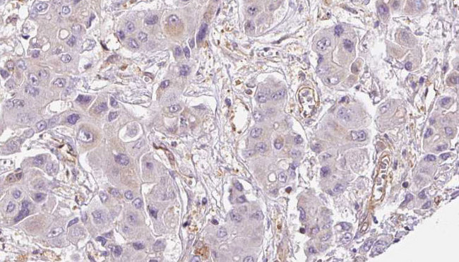 OR2A12 Antibody - 1:100 staining human liver carcinoma tissues by IHC-P. The sample was formaldehyde fixed and a heat mediated antigen retrieval step in citrate buffer was performed. The sample was then blocked and incubated with the antibody for 1.5 hours at 22°C. An HRP conjugated goat anti-rabbit antibody was used as the secondary.