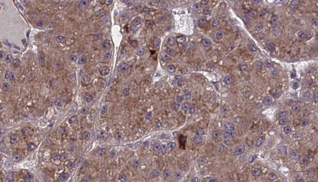 OR2A2 Antibody - 1:100 staining human liver carcinoma tissues by IHC-P. The sample was formaldehyde fixed and a heat mediated antigen retrieval step in citrate buffer was performed. The sample was then blocked and incubated with the antibody for 1.5 hours at 22°C. An HRP conjugated goat anti-rabbit antibody was used as the secondary.
