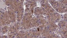 OR2A2 Antibody - 1:100 staining human liver carcinoma tissues by IHC-P. The sample was formaldehyde fixed and a heat mediated antigen retrieval step in citrate buffer was performed. The sample was then blocked and incubated with the antibody for 1.5 hours at 22°C. An HRP conjugated goat anti-rabbit antibody was used as the secondary.