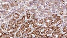OR2A42 Antibody - 1:100 staining human liver carcinoma tissues by IHC-P. The sample was formaldehyde fixed and a heat mediated antigen retrieval step in citrate buffer was performed. The sample was then blocked and incubated with the antibody for 1.5 hours at 22°C. An HRP conjugated goat anti-rabbit antibody was used as the secondary.