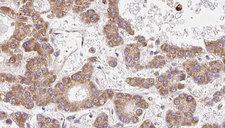 OR2B3 Antibody - 1:100 staining human liver carcinoma tissues by IHC-P. The sample was formaldehyde fixed and a heat mediated antigen retrieval step in citrate buffer was performed. The sample was then blocked and incubated with the antibody for 1.5 hours at 22°C. An HRP conjugated goat anti-rabbit antibody was used as the secondary.
