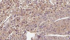 OR2B6 Antibody - 1:100 staining human liver carcinoma tissues by IHC-P. The sample was formaldehyde fixed and a heat mediated antigen retrieval step in citrate buffer was performed. The sample was then blocked and incubated with the antibody for 1.5 hours at 22°C. An HRP conjugated goat anti-rabbit antibody was used as the secondary.