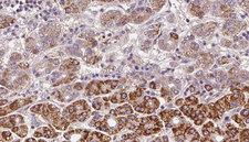 OR2C3 Antibody - 1:100 staining human liver carcinoma tissues by IHC-P. The sample was formaldehyde fixed and a heat mediated antigen retrieval step in citrate buffer was performed. The sample was then blocked and incubated with the antibody for 1.5 hours at 22°C. An HRP conjugated goat anti-rabbit antibody was used as the secondary.