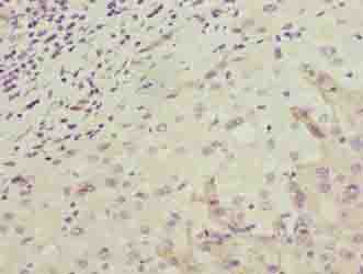 OR2H1 Antibody - Immunohistochemistry of paraffin-embedded human liver cancer using antibody at dilution of 1:100.