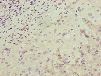 OR2H1 Antibody - Immunohistochemistry of paraffin-embedded human liver cancer using OR2H1 Antibody at dilution of 1:100