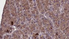 OR2H1 Antibody - 1:100 staining human liver carcinoma tissues by IHC-P. The sample was formaldehyde fixed and a heat mediated antigen retrieval step in citrate buffer was performed. The sample was then blocked and incubated with the antibody for 1.5 hours at 22°C. An HRP conjugated goat anti-rabbit antibody was used as the secondary.