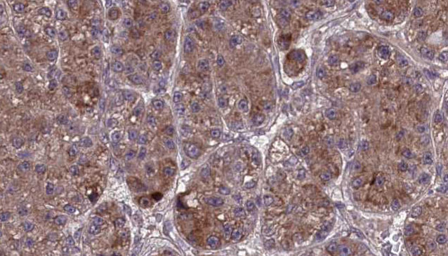 OR2L3 Antibody - 1:100 staining human liver carcinoma tissues by IHC-P. The sample was formaldehyde fixed and a heat mediated antigen retrieval step in citrate buffer was performed. The sample was then blocked and incubated with the antibody for 1.5 hours at 22°C. An HRP conjugated goat anti-rabbit antibody was used as the secondary.