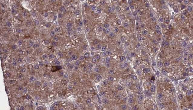 OR2M4 Antibody - 1:100 staining human liver carcinoma tissues by IHC-P. The sample was formaldehyde fixed and a heat mediated antigen retrieval step in citrate buffer was performed. The sample was then blocked and incubated with the antibody for 1.5 hours at 22°C. An HRP conjugated goat anti-rabbit antibody was used as the secondary.