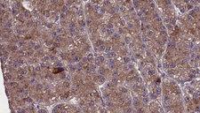 OR2M4 Antibody - 1:100 staining human liver carcinoma tissues by IHC-P. The sample was formaldehyde fixed and a heat mediated antigen retrieval step in citrate buffer was performed. The sample was then blocked and incubated with the antibody for 1.5 hours at 22°C. An HRP conjugated goat anti-rabbit antibody was used as the secondary.