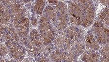 OR2S2 Antibody - 1:100 staining human liver carcinoma tissues by IHC-P. The sample was formaldehyde fixed and a heat mediated antigen retrieval step in citrate buffer was performed. The sample was then blocked and incubated with the antibody for 1.5 hours at 22°C. An HRP conjugated goat anti-rabbit antibody was used as the secondary.