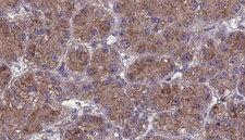 OR2T27 Antibody - 1:100 staining human liver carcinoma tissues by IHC-P. The sample was formaldehyde fixed and a heat mediated antigen retrieval step in citrate buffer was performed. The sample was then blocked and incubated with the antibody for 1.5 hours at 22°C. An HRP conjugated goat anti-rabbit antibody was used as the secondary.