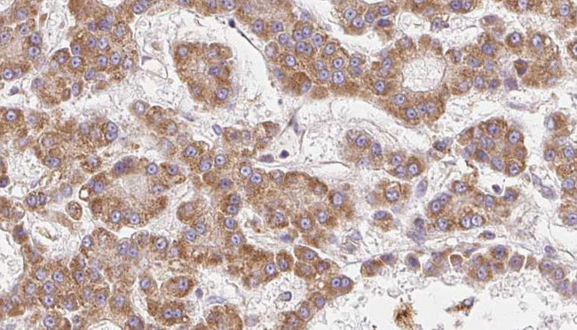 OR2V2 Antibody - 1:100 staining human liver carcinoma tissues by IHC-P. The sample was formaldehyde fixed and a heat mediated antigen retrieval step in citrate buffer was performed. The sample was then blocked and incubated with the antibody for 1.5 hours at 22°C. An HRP conjugated goat anti-rabbit antibody was used as the secondary.