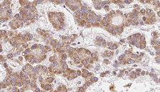 OR2V2 Antibody - 1:100 staining human liver carcinoma tissues by IHC-P. The sample was formaldehyde fixed and a heat mediated antigen retrieval step in citrate buffer was performed. The sample was then blocked and incubated with the antibody for 1.5 hours at 22°C. An HRP conjugated goat anti-rabbit antibody was used as the secondary.